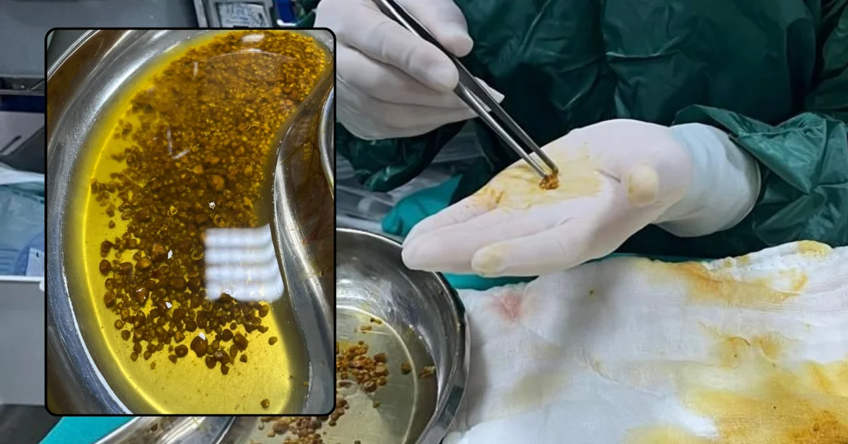 Doktorlar bile şaşırdı: Safra kesesinden 2 bin 67 taş çıktı