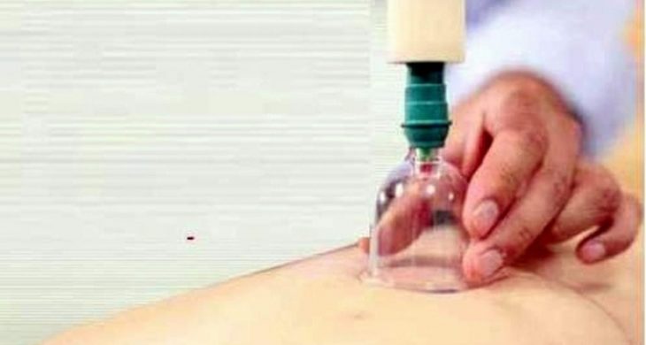 Hacamat Tedavisi Ve Bilinmeyenleri