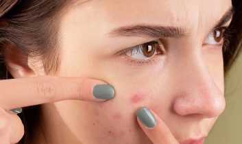 Akne Lekesi Kalmasın İstiyorsanız