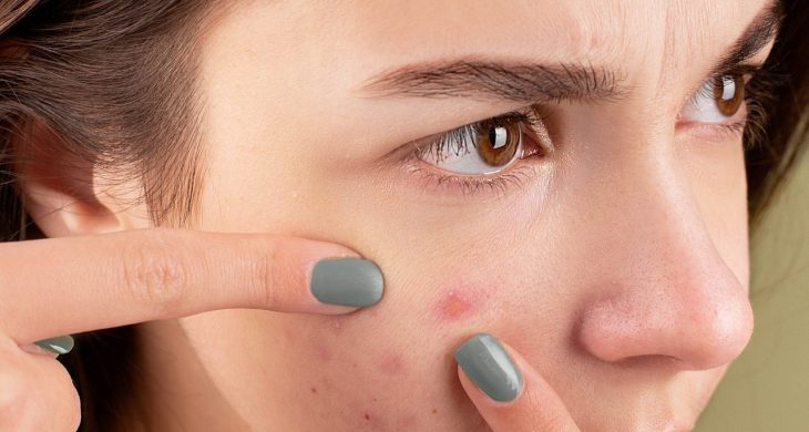 Akne Lekesi Kalmasın İstiyorsanız