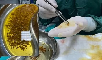 Doktorlar bile şaşırdı: Safra kesesinden 2 bin 67 taş çıktı