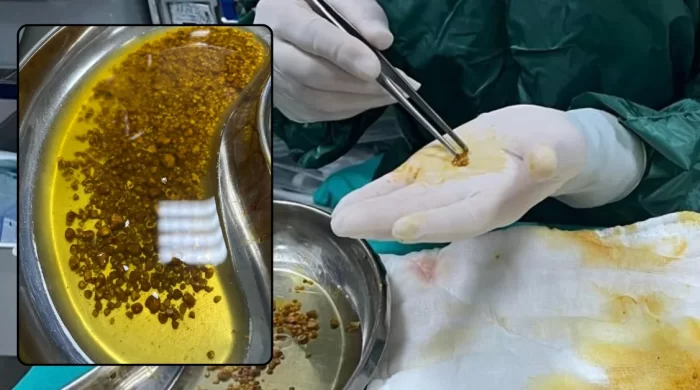 Doktorlar bile şaşırdı: Safra kesesinden 2 bin 67 taş çıktı
