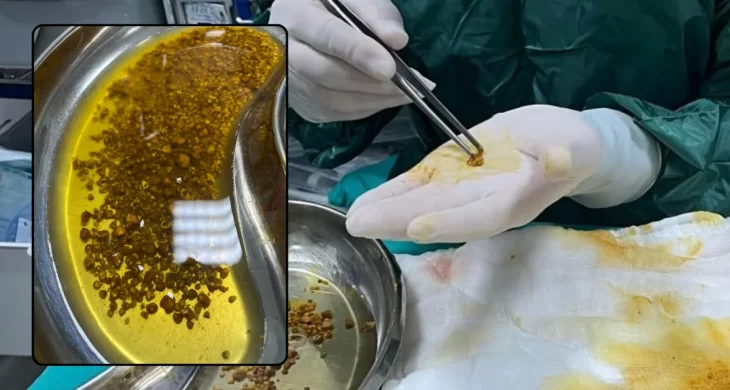 Doktorlar bile şaşırdı: Safra kesesinden 2 bin 67 taş çıktı