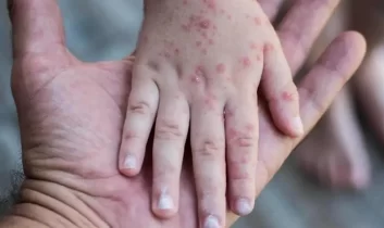 Endonezya’da kızamık salgını: 17 kişi hayatını kaybetti