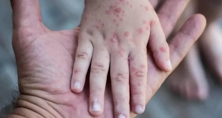 Endonezya’da kızamık salgını: 17 kişi hayatını kaybetti