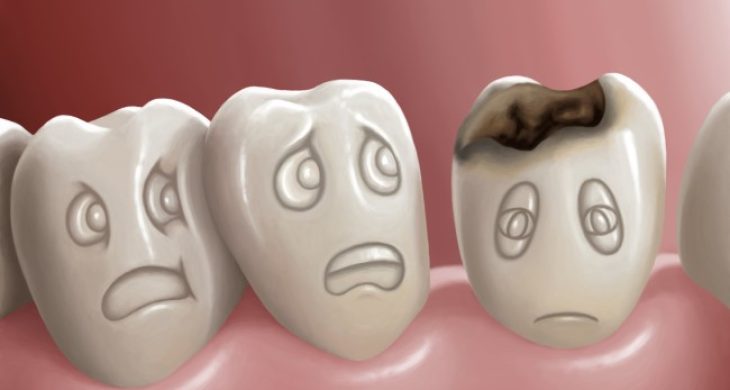 Çürükleri Önlemenin 10 Temel Yolu