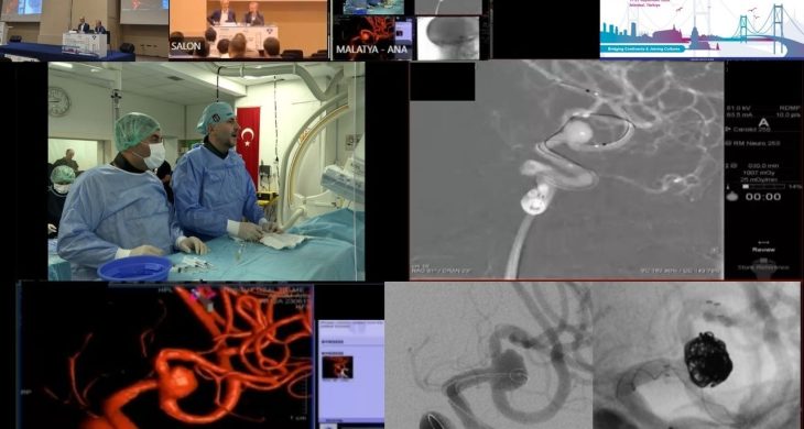 Malatya’dan dünyaya tıbbi başarı: Beyin baloncuğu tedavisi canlı yayında yapıldı